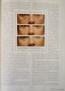 Dr. Lauren Greenberg photo of lower eyelid surgery with fat transfer to cheek