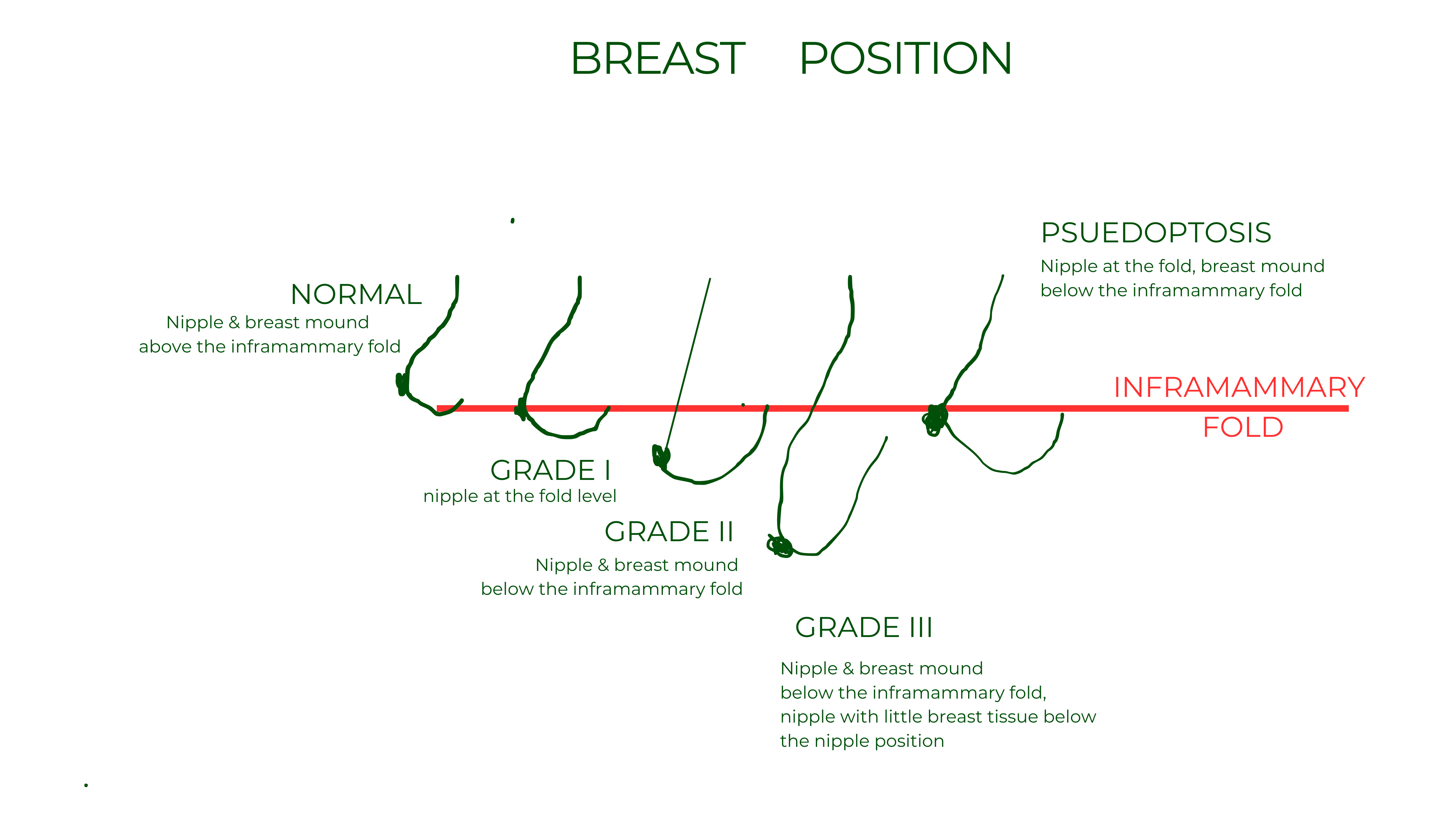 How Do Plastic Surgeons Evaluate Breast Drooping