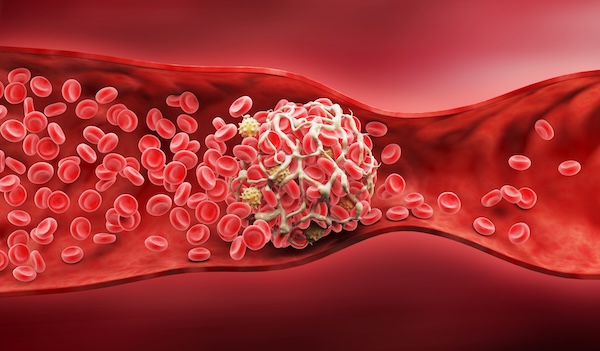 Preventing Blood Clots in Plastic Surgery: What You Need to Know